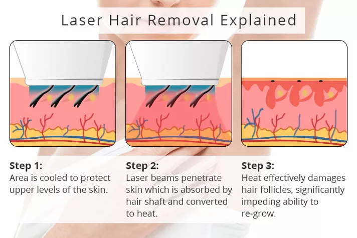 how laser works